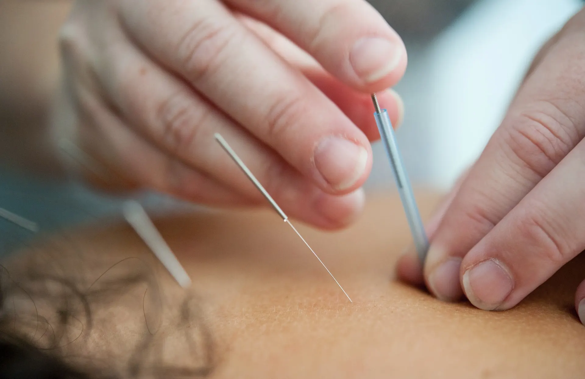 acupuncture for hot flashes